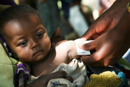 Over 7 Million Children Under 5 Malnourished in Ethiopia, Kenya, and Somalia