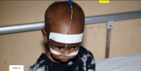 Severe Child Malnutrition Crisis Affects 500,000 Somali Kids