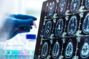 Dementia Treatment: Progress, Innovation, and Hope for 982,000 People