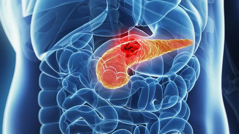 Pancreatic cancer breakthrough