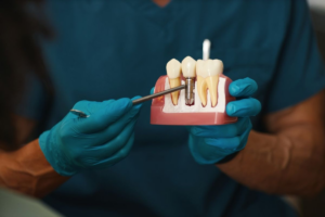 Better dental implants: A new Russian breakthrough Better dental implants: A new Russian breakthrough