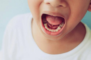 What is fast cavity treatment and how does it help kids? What is fast cavity treatment and how does it help kids?